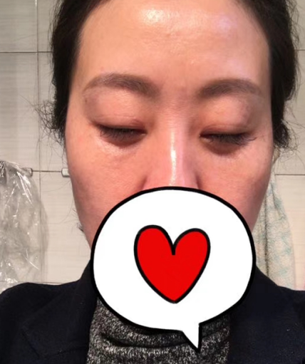 去眼袋手术