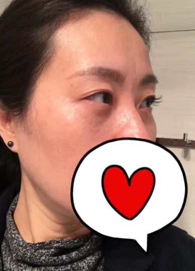 去眼袋手术
