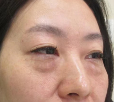 去眼袋手术