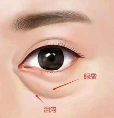 去眼袋手术