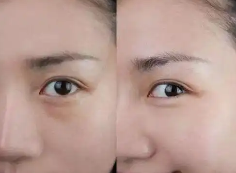 去眼袋手术