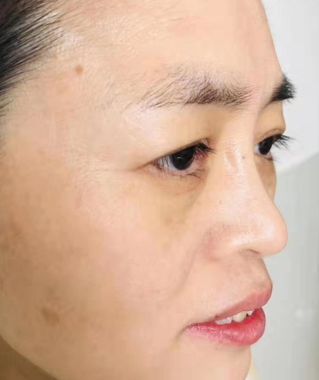 去眼袋手术