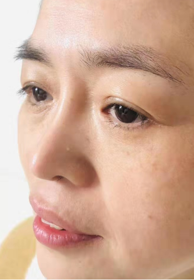 去眼袋手术