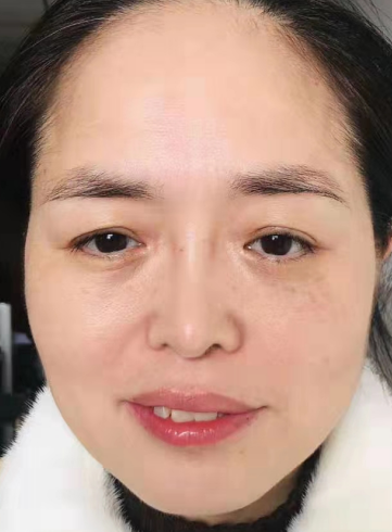 去眼袋手术