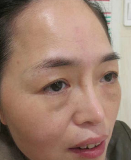 去眼袋手术