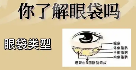 去眼袋手术