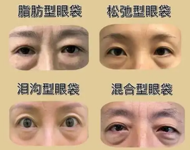 去眼袋手术