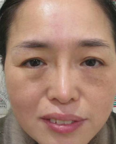 去眼袋手术