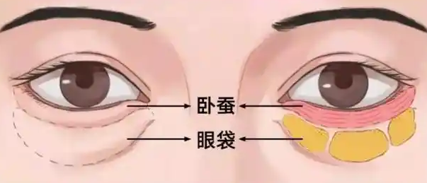 去眼袋手术