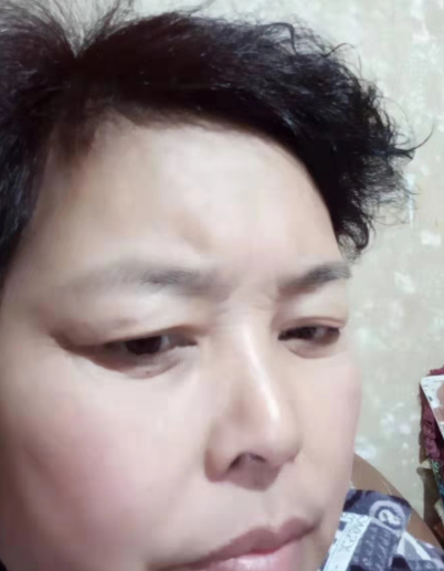 去眼袋手术