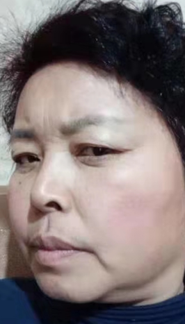 去眼袋手术