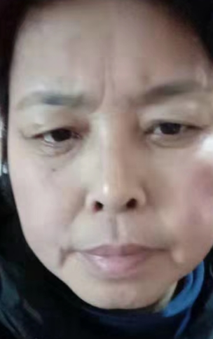 去眼袋手术