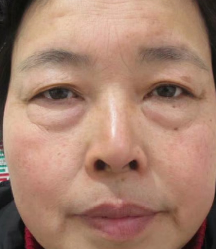 去眼袋手术