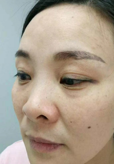 去眼袋手术