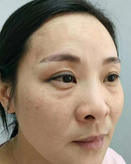 去眼袋手术