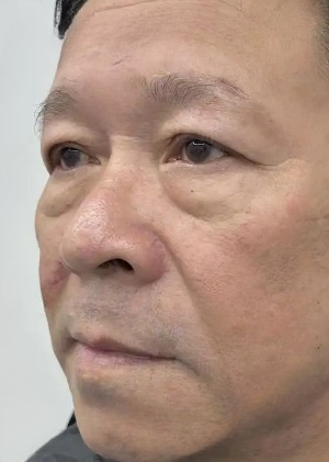 去眼袋手术