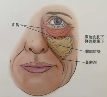 去眼袋手术