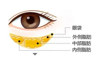 去眼袋手术
