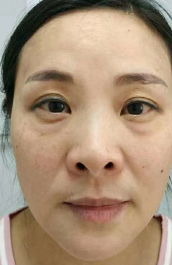 去眼袋手术
