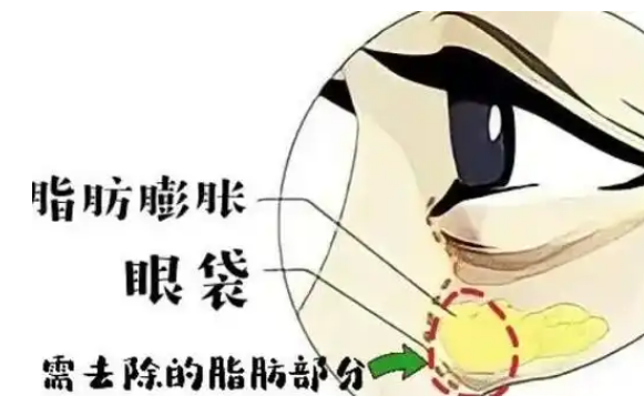 去眼袋手术