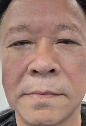 去眼袋手术