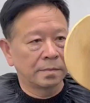 去眼袋手术