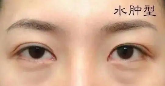 眼袋