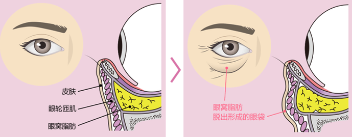 眼袋