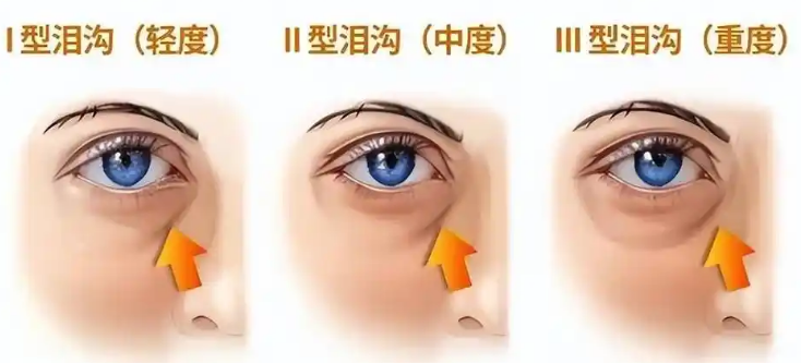 眼袋