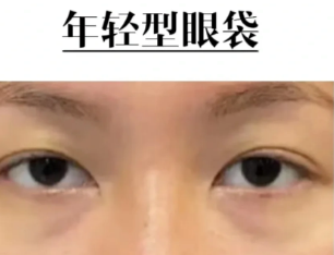 眼袋