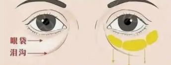 眼袋