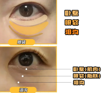 眼袋