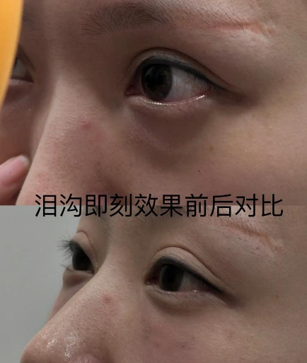 眼袋