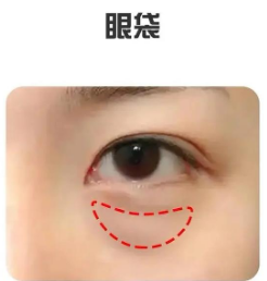 眼袋
