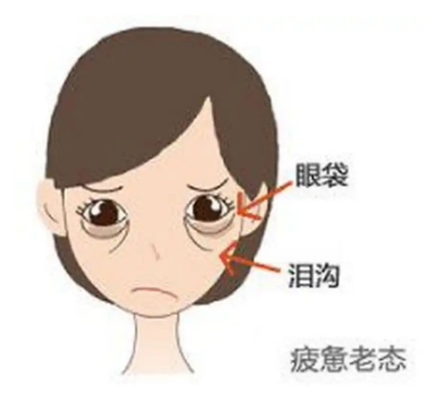 去眼袋手术