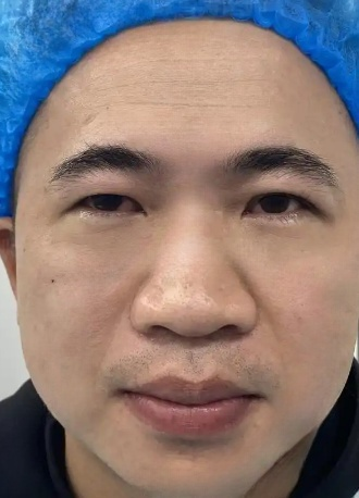 去眼袋手术