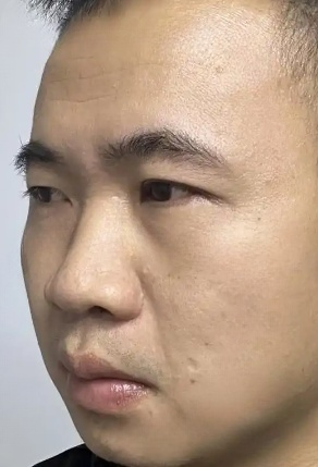 去眼袋手术