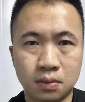 去眼袋手术