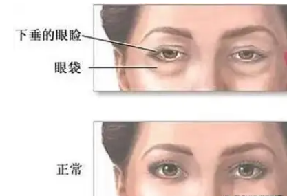 去眼袋手术