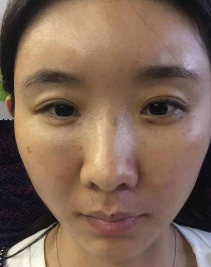 去眼袋手术