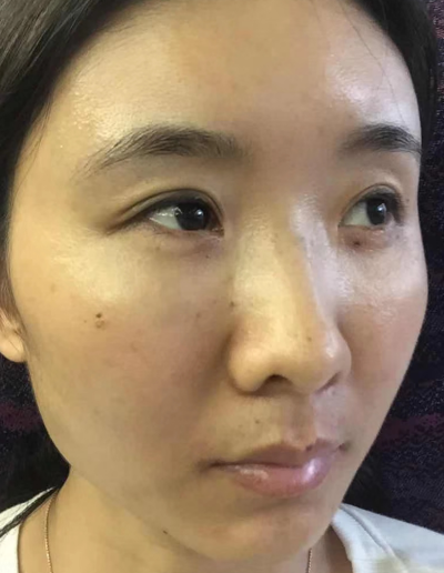 去眼袋手术