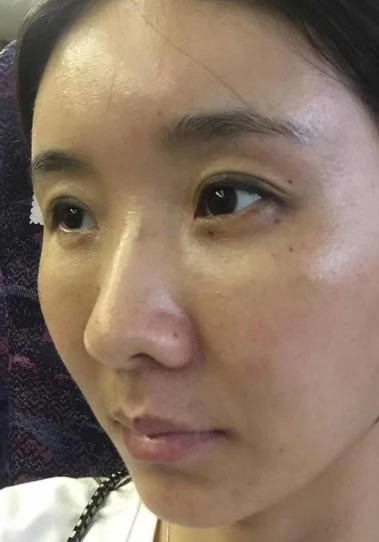 去眼袋手术