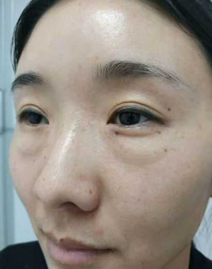 去眼袋手术