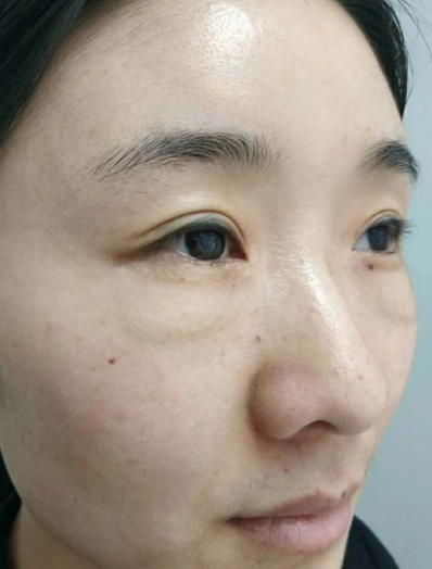 去眼袋手术