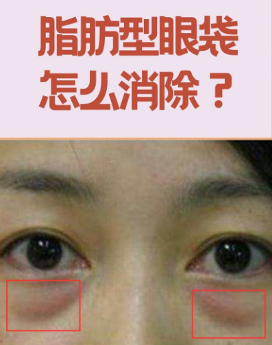 去眼袋手术