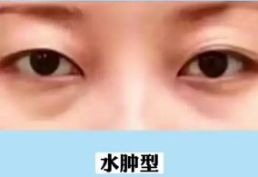 去眼袋手术