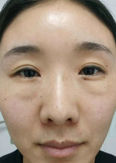 去眼袋手术
