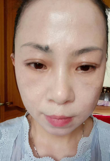 去眼袋手术