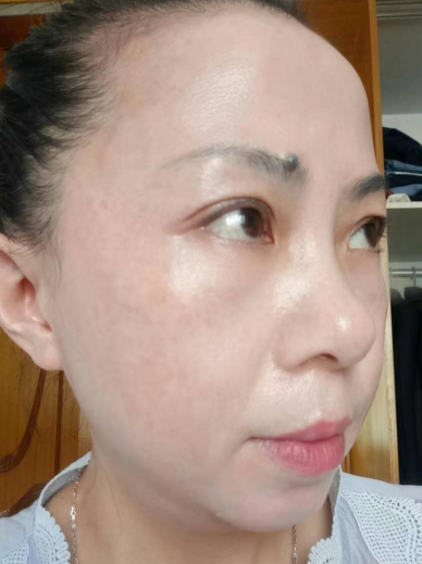 去眼袋手术