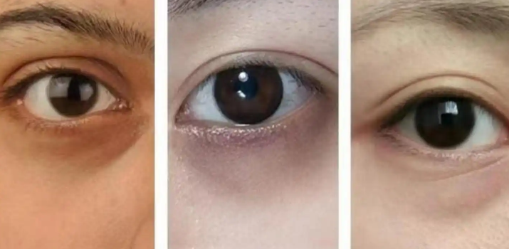 去眼袋手术